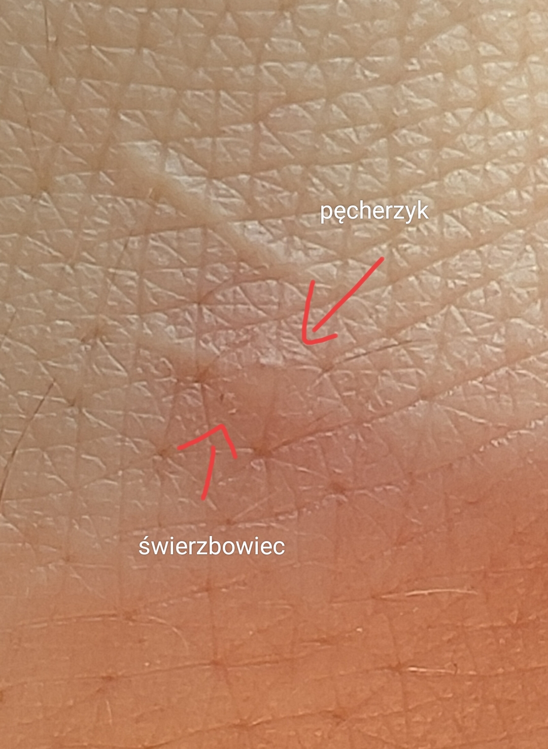 Świerzbowiec w naskórku